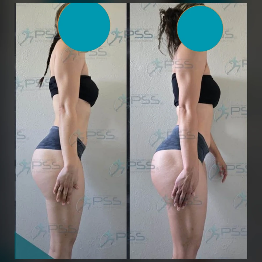 Testimonio Glute Max - Elevación y Redondez Glútea