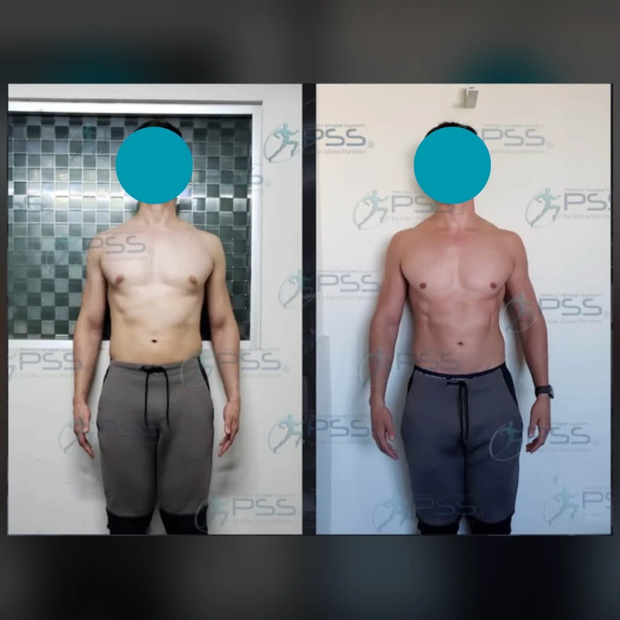 Testimonio Lipo Reductor - Definición Muscular y Vientre Plano